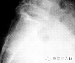 【病例】骶部脊膜瘤侵犯骶骨1例X线CT影像表现分析 【病例】骶部脊膜瘤侵犯骶骨1例X线CT影像表现分析