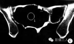 【病例】骶部脊膜瘤侵犯骶骨1例X线CT影像表现分析 【病例】骶部脊膜瘤侵犯骶骨1例X线CT影像表现分析