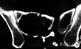【病例】骶部脊膜瘤侵犯骶骨1例X线CT影像表现分析 【病例】骶部脊膜瘤侵犯骶骨1例X线CT影像表现分析