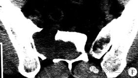 【病例】骶部脊膜瘤侵犯骶骨1例X线CT影像表现分析 【病例】骶部脊膜瘤侵犯骶骨1例X线CT影像表现分析