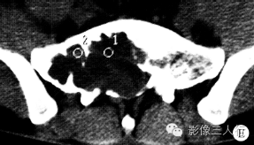 【病例】骶部脊膜瘤侵犯骶骨1例X线CT影像表现分析 【病例】骶部脊膜瘤侵犯骶骨1例X线CT影像表现分析