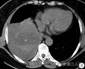 【病例】右膈肌平滑肌肉瘤黏液变性1例CT影像表现