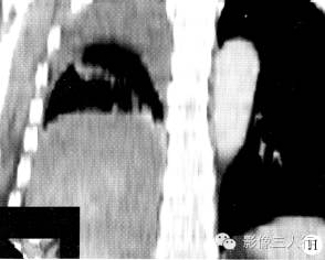 【病例】右膈肌平滑肌肉瘤黏液变性1例CT影像表现