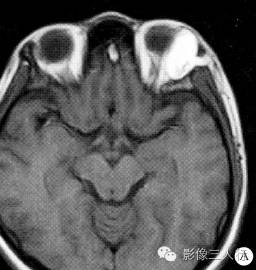 【病例】左眼眶皮样囊肿1例CT及MR影像表现分析 【病例】左眼眶皮样囊肿1例CT及MR影像表现分析