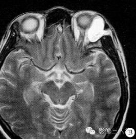 【病例】左眼眶皮样囊肿1例CT及MR影像表现分析 【病例】左眼眶皮样囊肿1例CT及MR影像表现分析