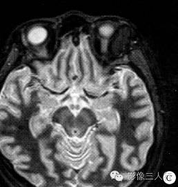【病例】左眼眶皮样囊肿1例CT及MR影像表现分析 【病例】左眼眶皮样囊肿1例CT及MR影像表现分析