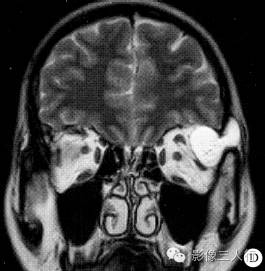 【病例】左眼眶皮样囊肿1例CT及MR影像表现分析