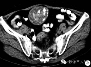 【病例】盆腔内陈旧性血吸虫卵结节1例CT影像分析
