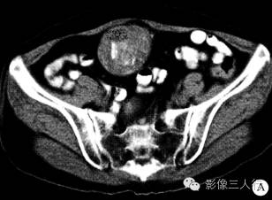 【病例】盆腔内陈旧性血吸虫卵结节1例CT影像分析