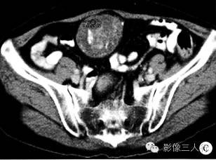 【病例】盆腔内陈旧性血吸虫卵结节1例CT影像分析
