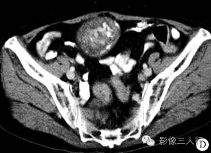 【病例】盆腔内陈旧性血吸虫卵结节1例CT影像分析