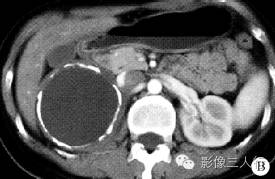 【病例】腹膜后神经节细胞瘤 1例CT影像分析 【病例】腹膜后神经节细胞瘤 1例CT影像分析