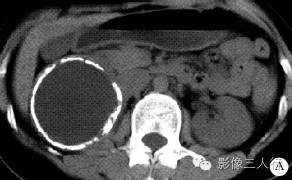 【病例】腹膜后神经节细胞瘤 1例CT影像分析
