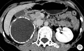 【病例】腹膜后神经节细胞瘤 1例CT影像分析 【病例】腹膜后神经节细胞瘤 1例CT影像分析