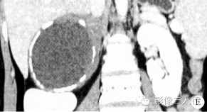 【病例】腹膜后神经节细胞瘤 1例CT影像分析 【病例】腹膜后神经节细胞瘤 1例CT影像分析