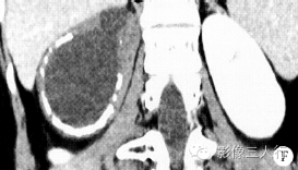 【病例】腹膜后神经节细胞瘤 1例CT影像分析 【病例】腹膜后神经节细胞瘤 1例CT影像分析