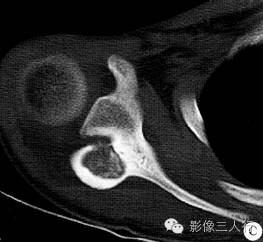 【病例】右侧肩胛骨骨母细胞瘤1例CT影像分析