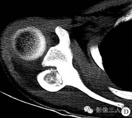 【病例】右侧肩胛骨骨母细胞瘤1例CT影像分析