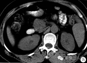 【病例】十二指肠降段平滑肌瘤1例CT影像表现分析 【病例】十二指肠降段平滑肌瘤1例CT影像表现分析