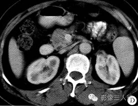 【病例】十二指肠降段平滑肌瘤1例CT影像表现分析 【病例】十二指肠降段平滑肌瘤1例CT影像表现分析