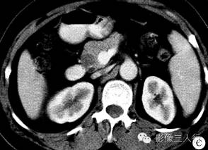 【病例】十二指肠降段平滑肌瘤1例CT影像表现分析 【病例】十二指肠降段平滑肌瘤1例CT影像表现分析