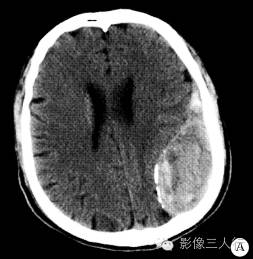 【病例】左侧颞顶硬膜下血肿(部分机化)1例CT及MR影像表现分析