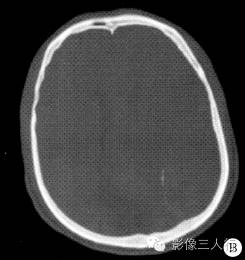 【病例】左侧颞顶硬膜下血肿(部分机化)1例CT及MR影像表现分析 【病例】左侧颞顶硬膜下血肿(部分机化)1例CT及MR影像表现分析