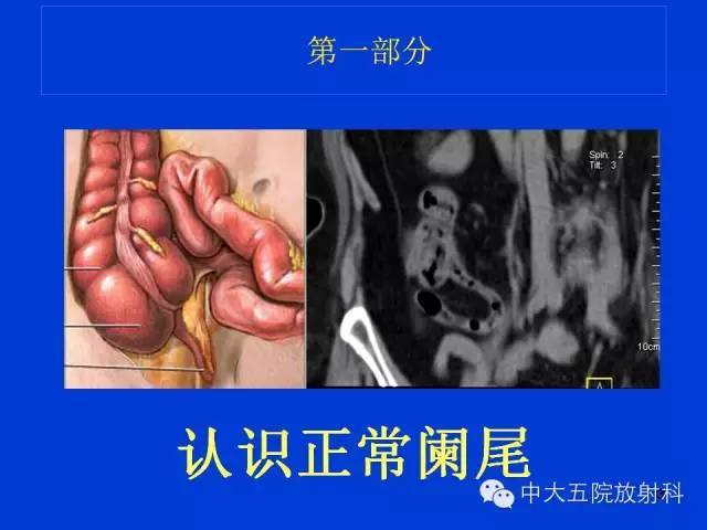 【PPT】正常阑尾和阑尾炎的CT表现