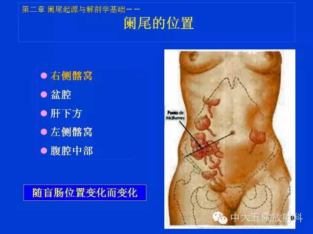 【PPT】正常阑尾和阑尾炎的CT表现