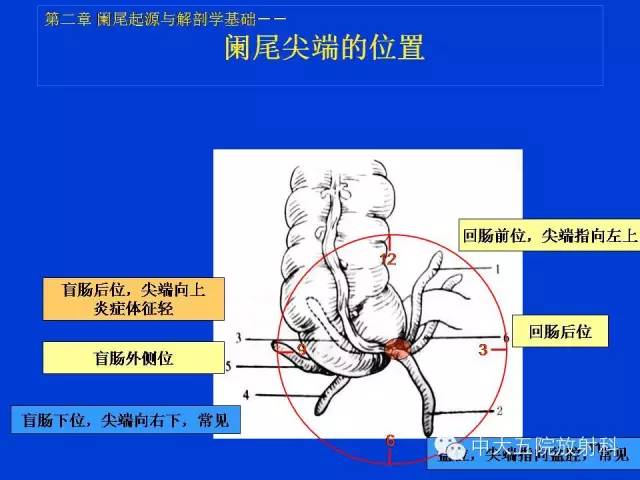 【PPT】正常阑尾和阑尾炎的CT表现