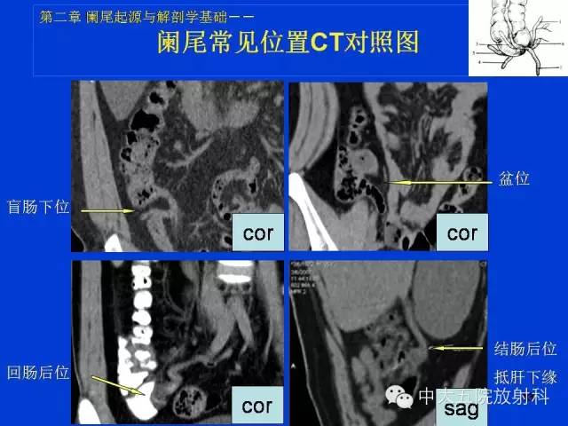 【PPT】正常阑尾和阑尾炎的CT表现