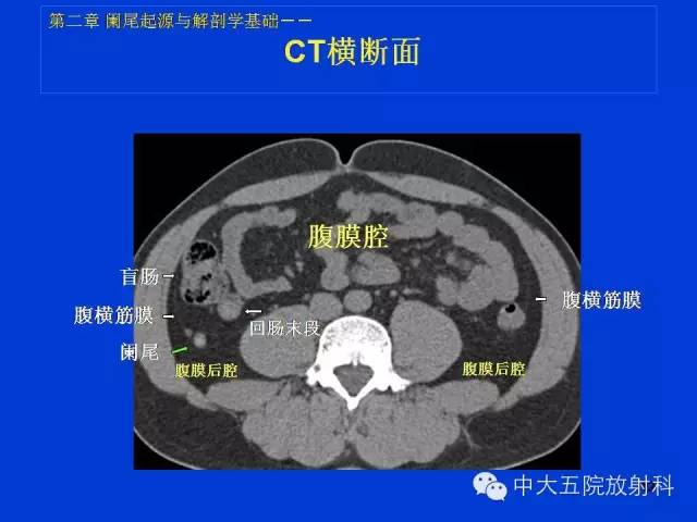 【PPT】正常阑尾和阑尾炎的CT表现