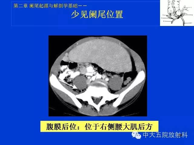 【PPT】正常阑尾和阑尾炎的CT表现