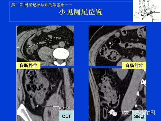 【PPT】正常阑尾和阑尾炎的CT表现