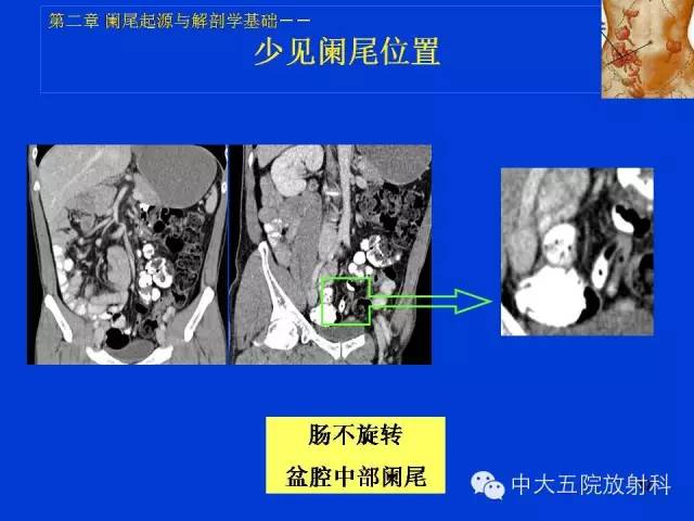 【PPT】正常阑尾和阑尾炎的CT表现