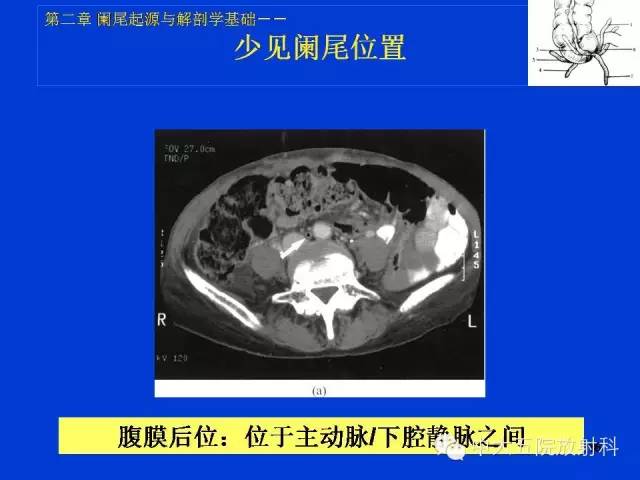 【PPT】正常阑尾和阑尾炎的CT表现