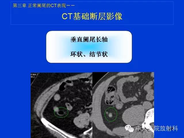 【PPT】正常阑尾和阑尾炎的CT表现
