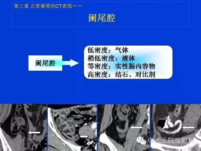 【PPT】正常阑尾和阑尾炎的CT表现