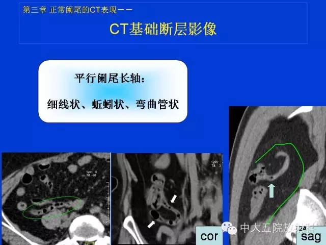 【PPT】正常阑尾和阑尾炎的CT表现