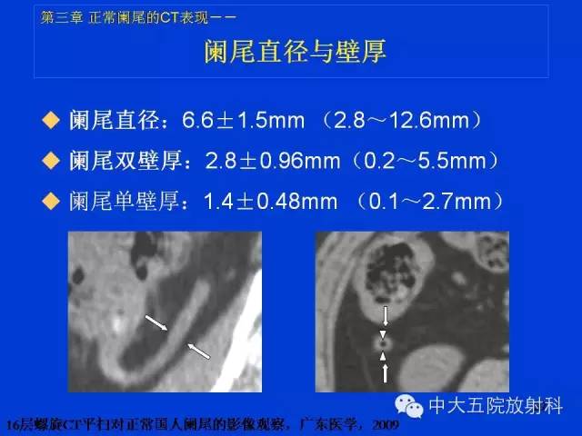 【PPT】正常阑尾和阑尾炎的CT表现