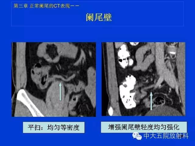 【PPT】正常阑尾和阑尾炎的CT表现