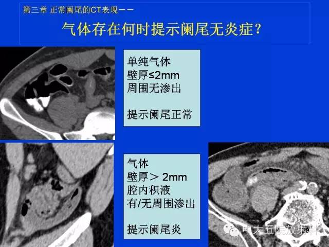 【PPT】正常阑尾和阑尾炎的CT表现