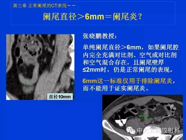 【PPT】正常阑尾和阑尾炎的CT表现