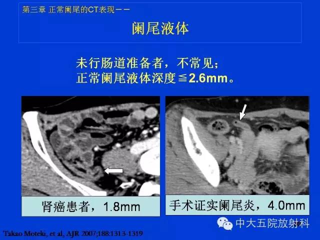【PPT】正常阑尾和阑尾炎的CT表现