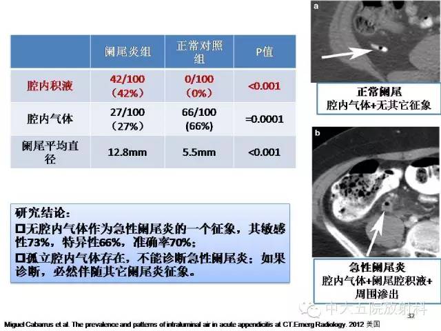 【PPT】正常阑尾和阑尾炎的CT表现