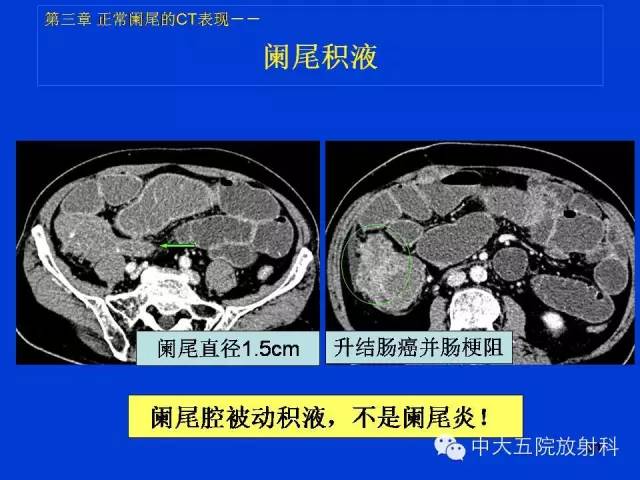 【PPT】正常阑尾和阑尾炎的CT表现