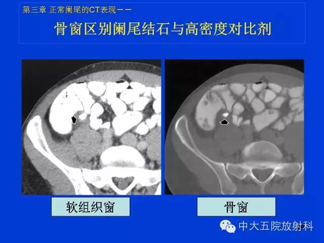 【PPT】正常阑尾和阑尾炎的CT表现