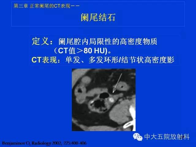 【PPT】正常阑尾和阑尾炎的CT表现