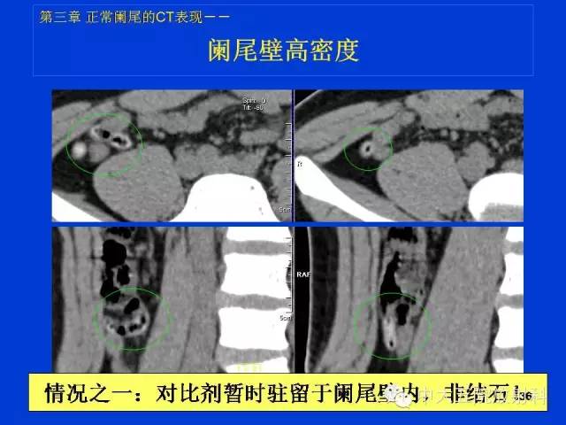 【PPT】正常阑尾和阑尾炎的CT表现