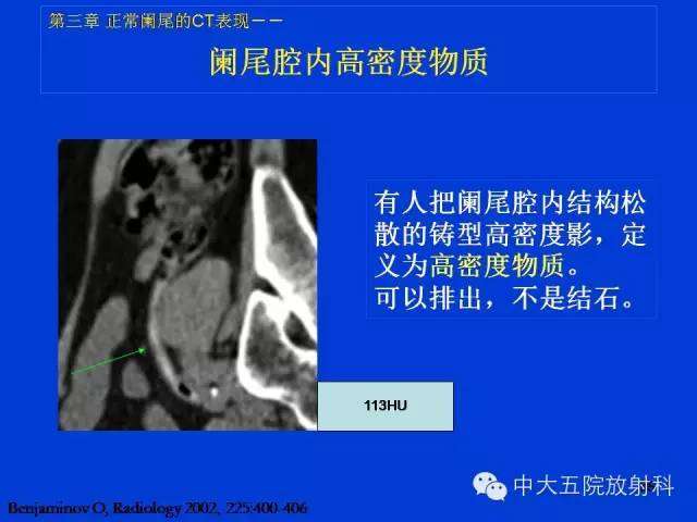 【PPT】正常阑尾和阑尾炎的CT表现